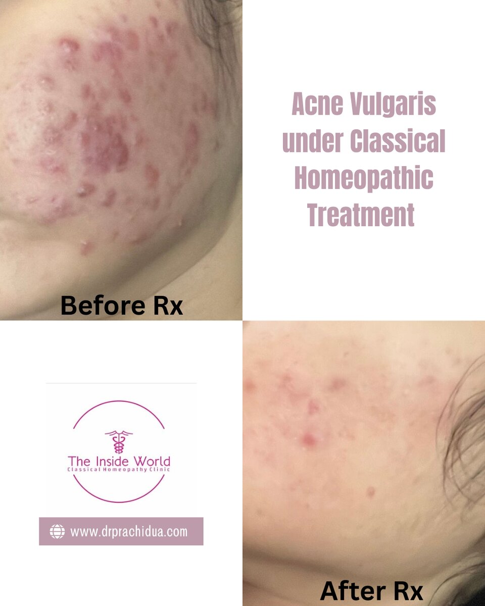 Acne — documented before and after under classical homeopathic treatment (shared with consent)